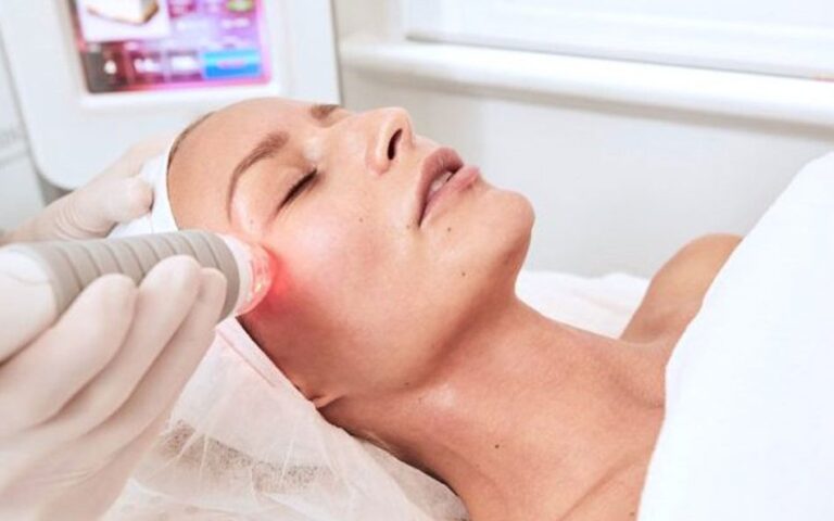 Vivace RF microneedling on a client’s face